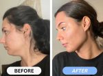 غبغب بند زاویه ساز صورت V Shape - Image 5